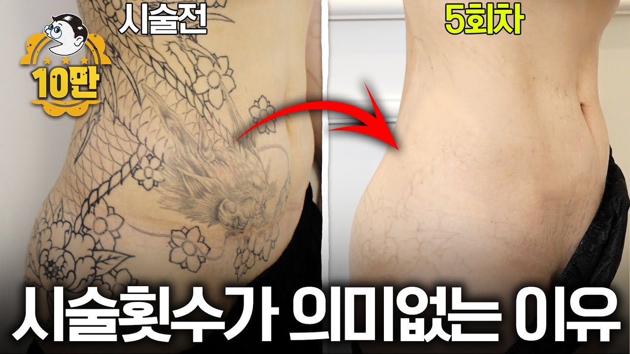 이렇게 큰 문신도 이정도로 지워질 수 있는거였어? | 영수쌤의 중간점검 EP.1