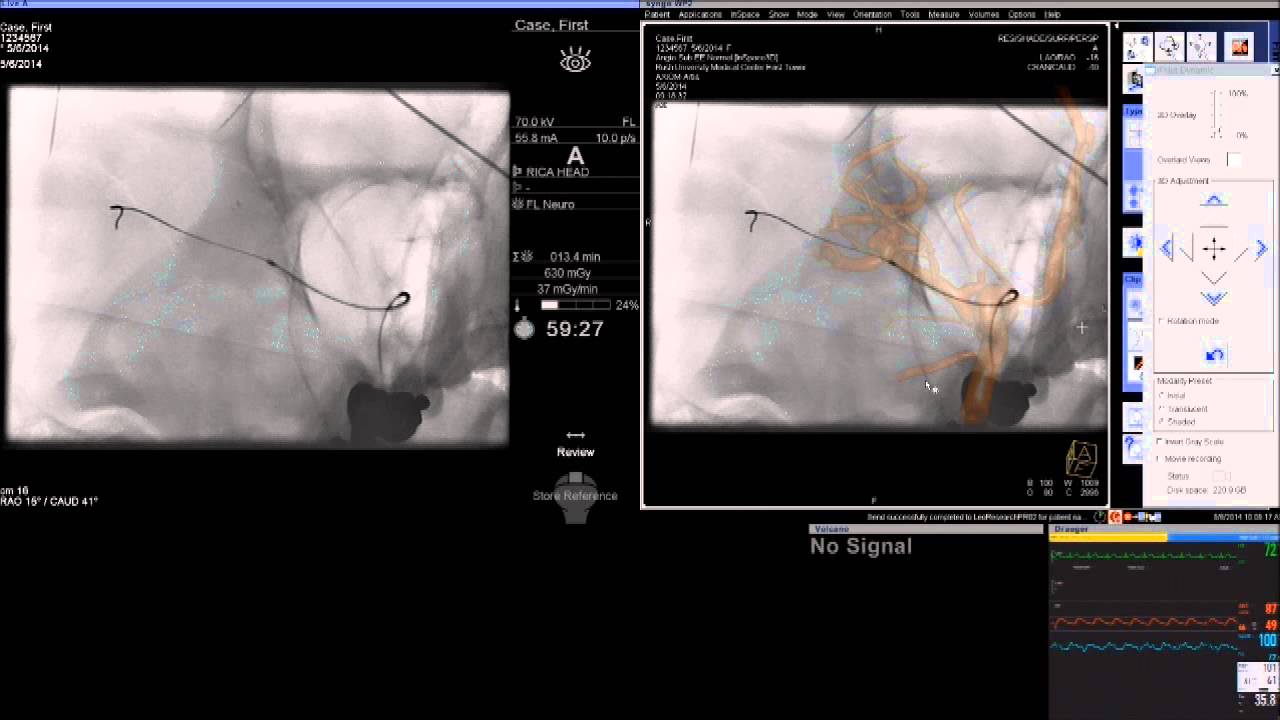 Y-Stent-Assisted Coil Embolization of Middle Cerebral Artery Aneurysm | Demetrius Lopes, MD