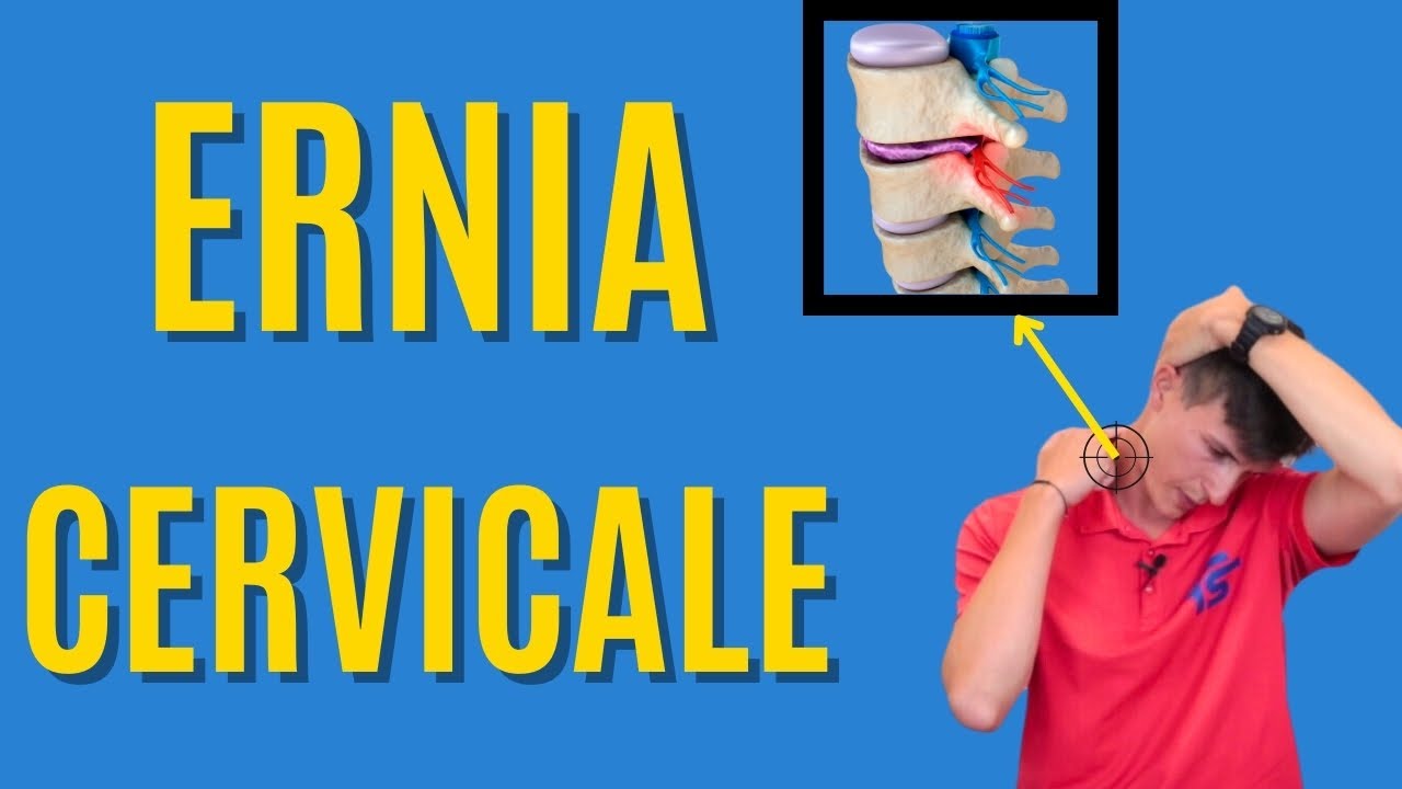 Ernia CERVICALE (C5-C6, C6-C7) - Consigli ed esercizi mirati!