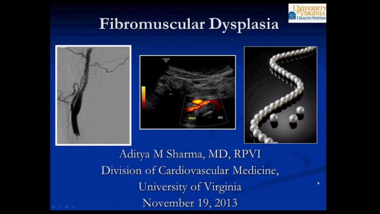 SIR-RFS Webinar (11/19/13): Fibromuscular Dysplasia