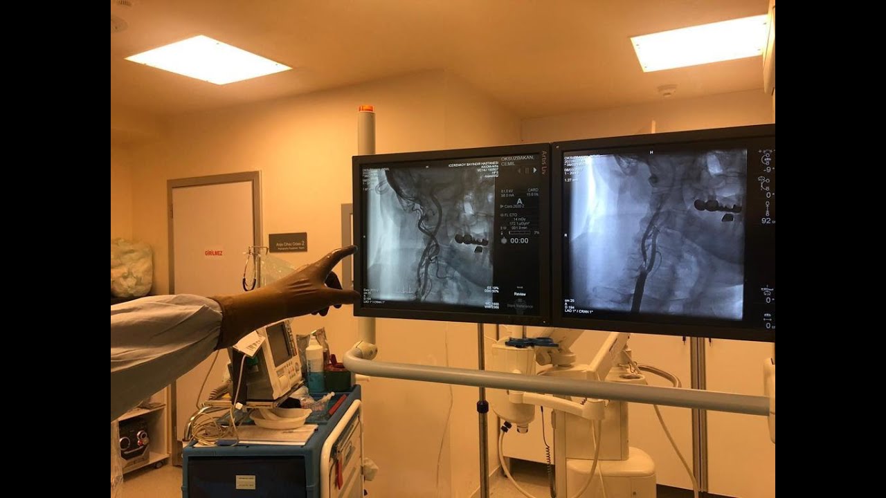 TIKALI BEYİN DAMARINA STENT İŞLEMİ