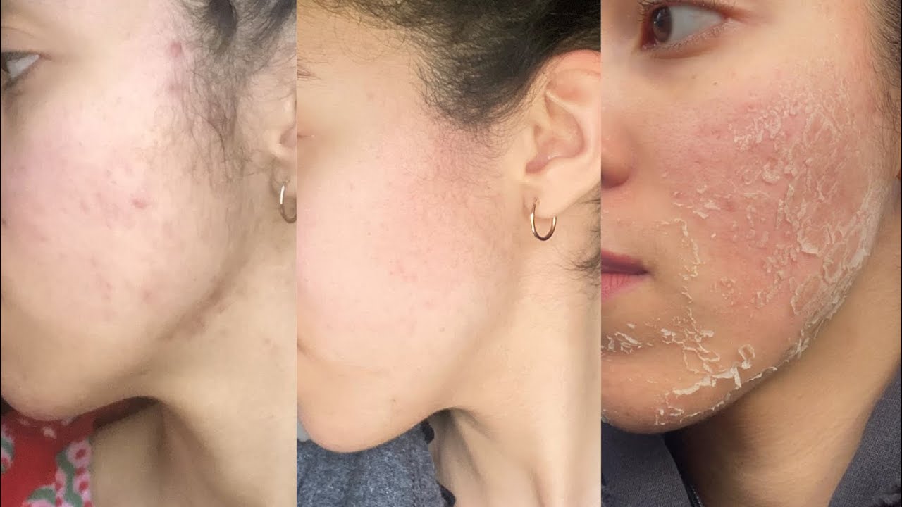 Peeling aux algues