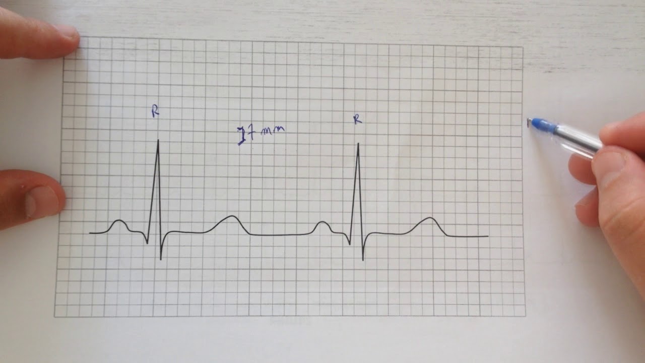 #Dica 16 - Aula 5 - Curso de Interpretação de ECG