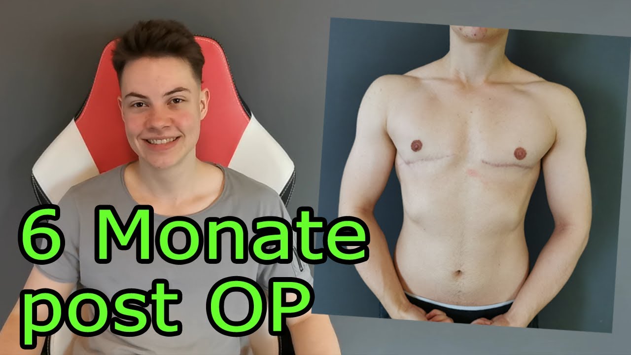 [GER/ENG] top surgery: 6 months after surgery and scar care
