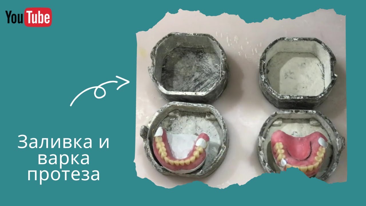 Заливка и варка зубного протеза. Этап 3