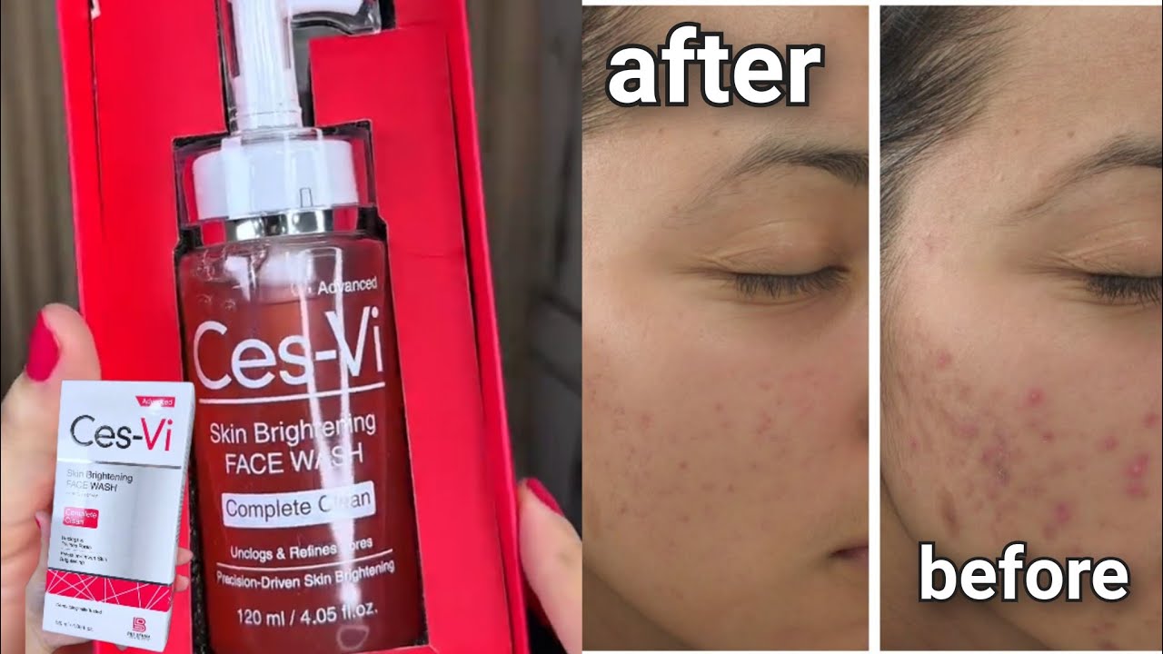 Ces-Vi Face Wash Review | Best Face Wash for Glowing & Clear Skin ✨". "Ces-Vi Face Wash Honest 