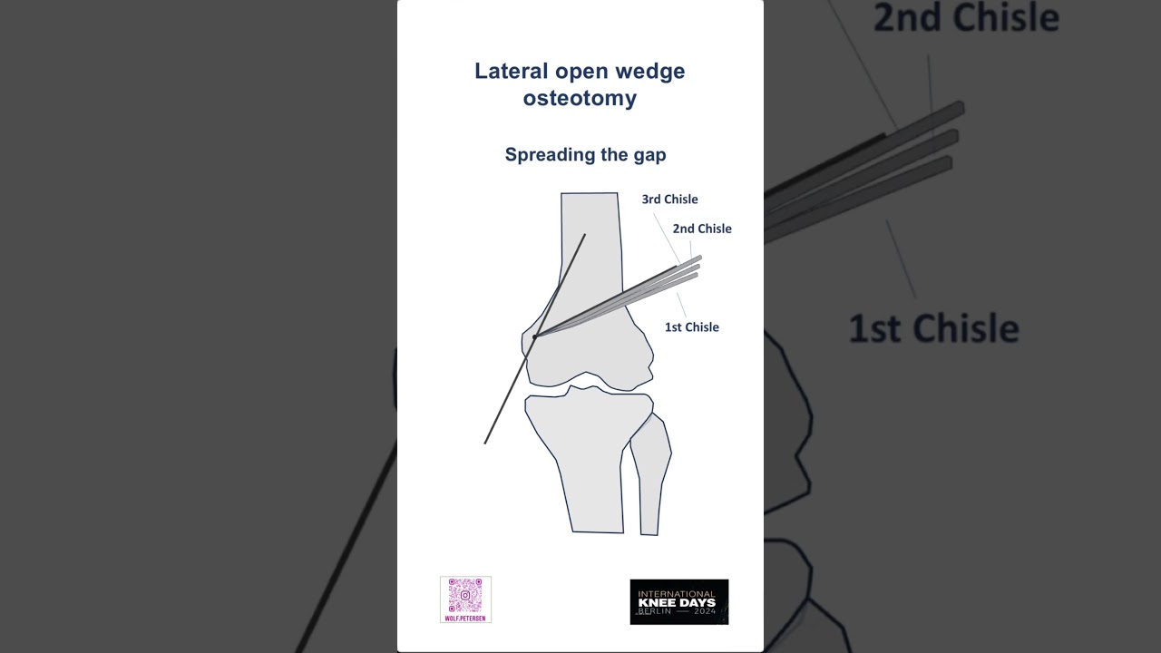 Short: Lateral open wedge distal femoral #osteotomy for treatment of lateral #osteoarthritis