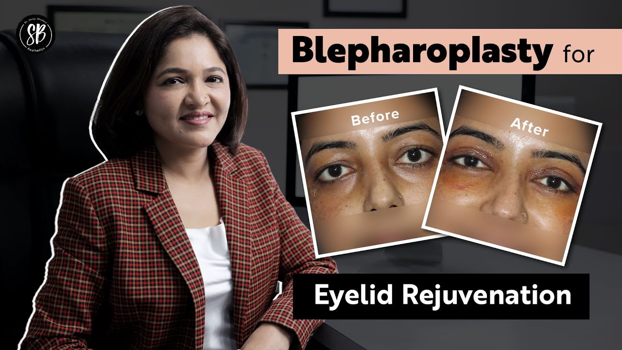All about Blepharoplasty: Under eye bags, Puffy eyes, Droopy eyelids | Eye Lid Surgery in Gurgaon
