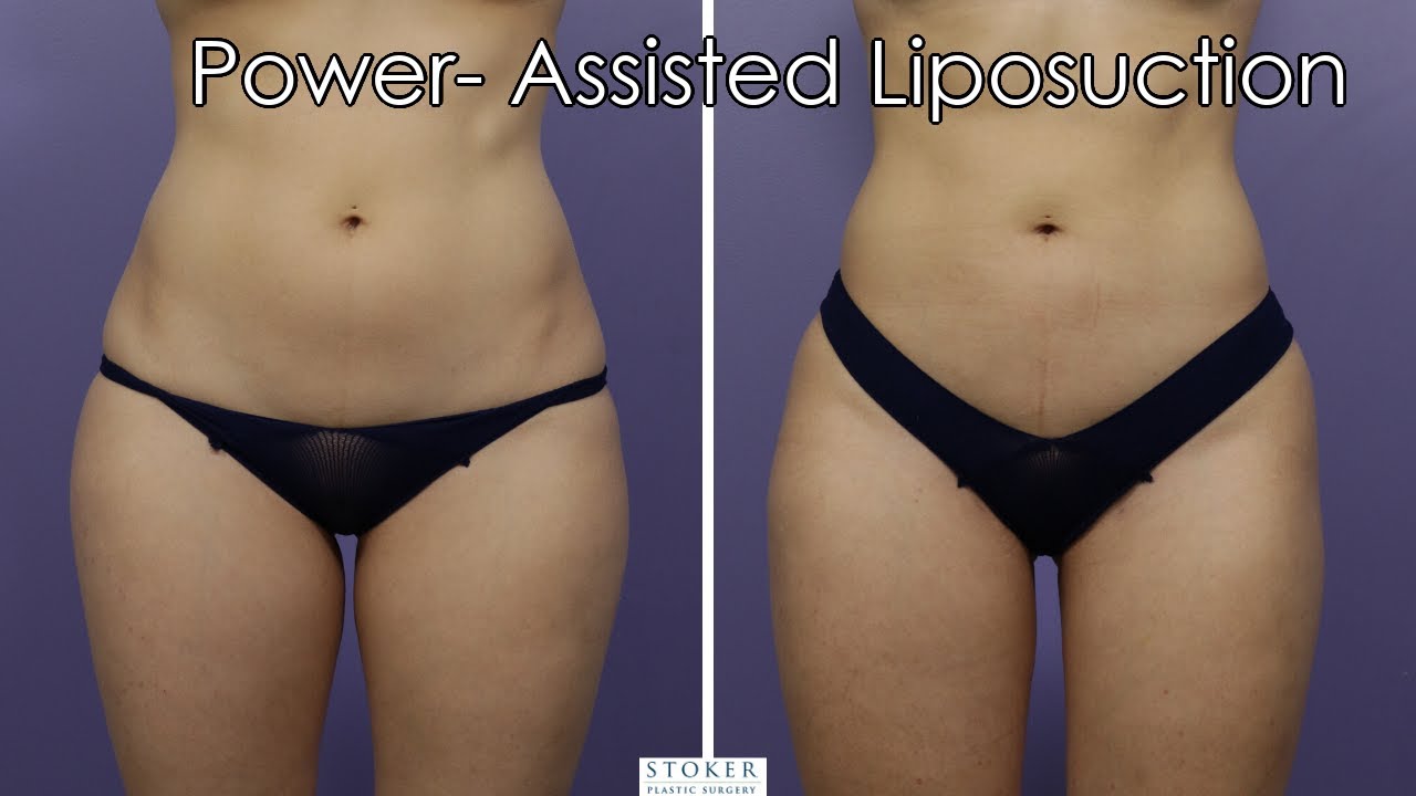 Liposuction Los Angeles: Plastic Surgeon Dr. David Stoker 360 Degree Body Contouring 1 Year Results
