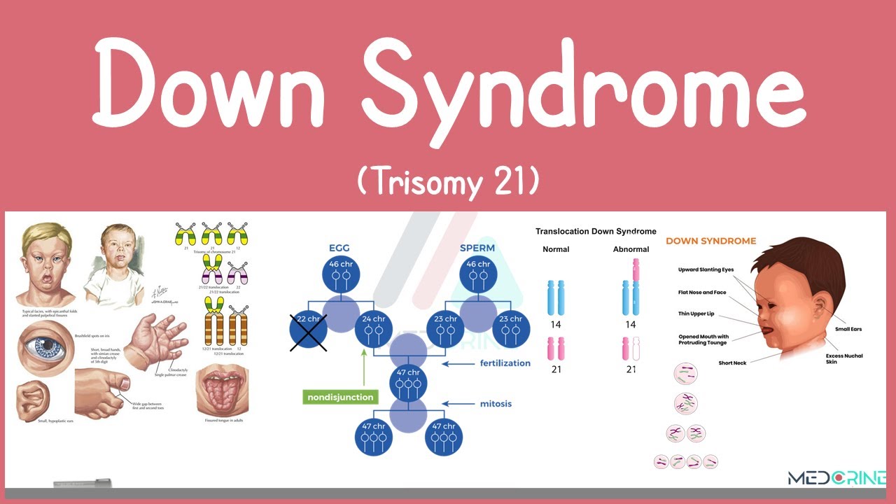 Down syndrome (Trisomy 21) - causes, symptoms, diagnosis, & pathology
