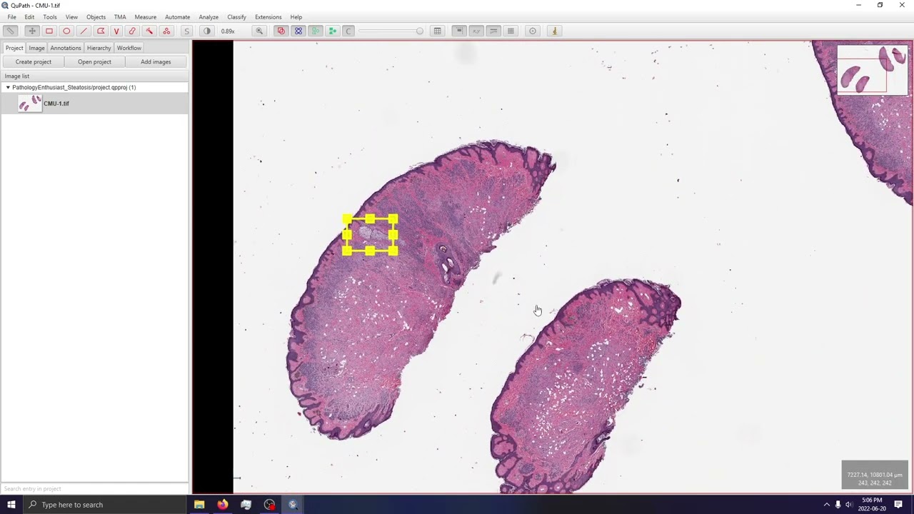Micro vs Macrovesicular steatosis for PathologyEnthusiast