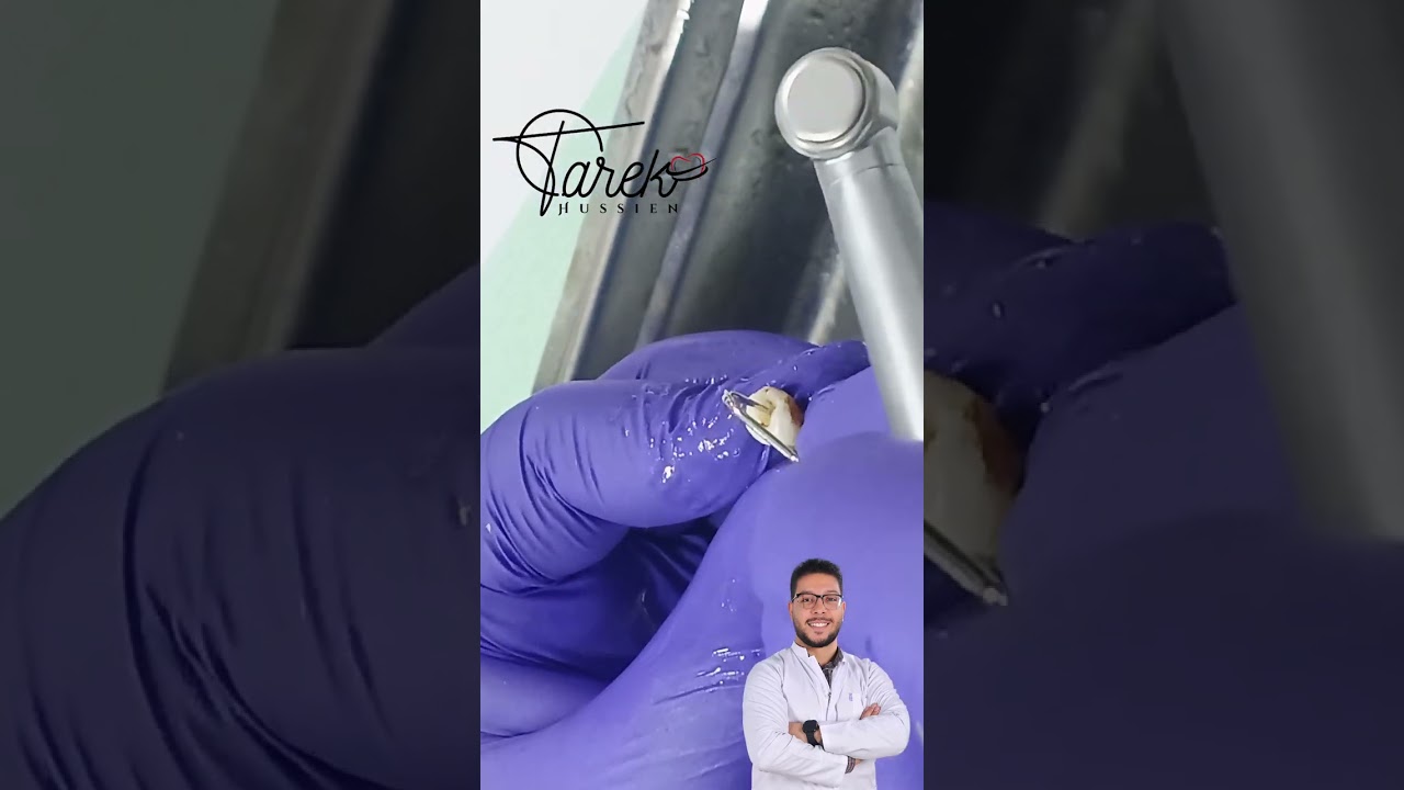 Access opening of lower premolar | Endodontic treatment | Tarek Hussien 