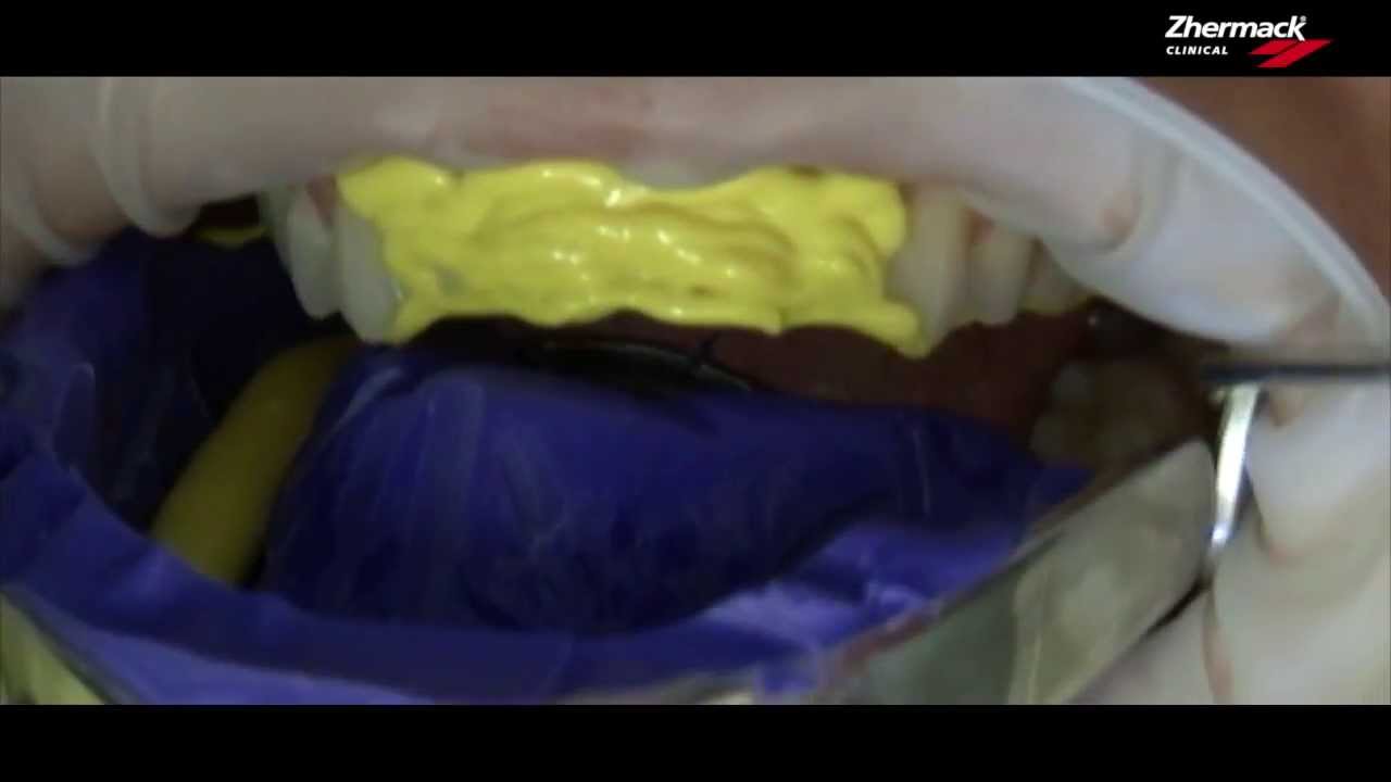 Hydrorise Video ITA - doppia impronta due viscosità