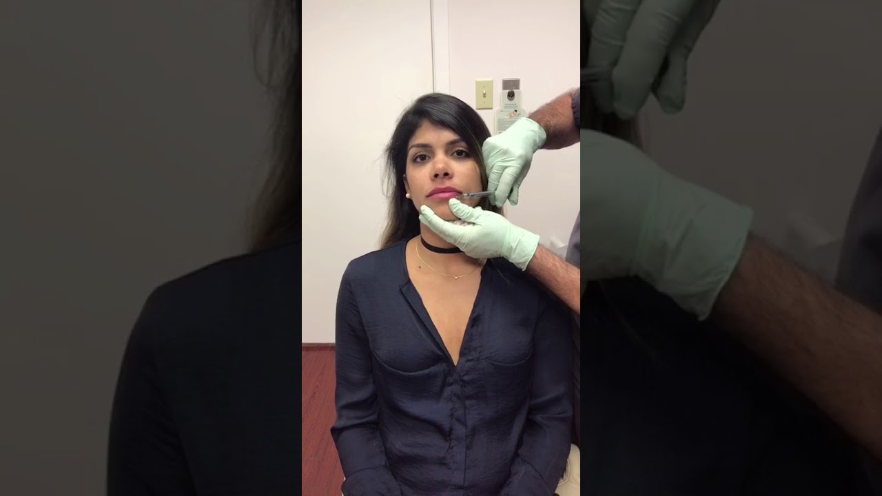 Lip Augmentation Part 2