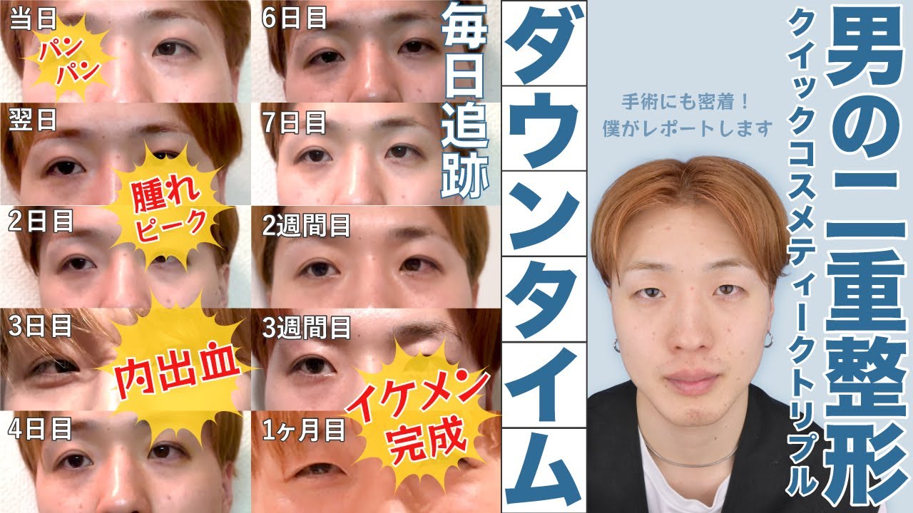【男の埋没】腫れや内出血あり！ダウンタイムを徹底レポ。クイックコスメティークトリプルで韓流系イケメンになりました！【二重整形】【クイックコスメティークダブル】