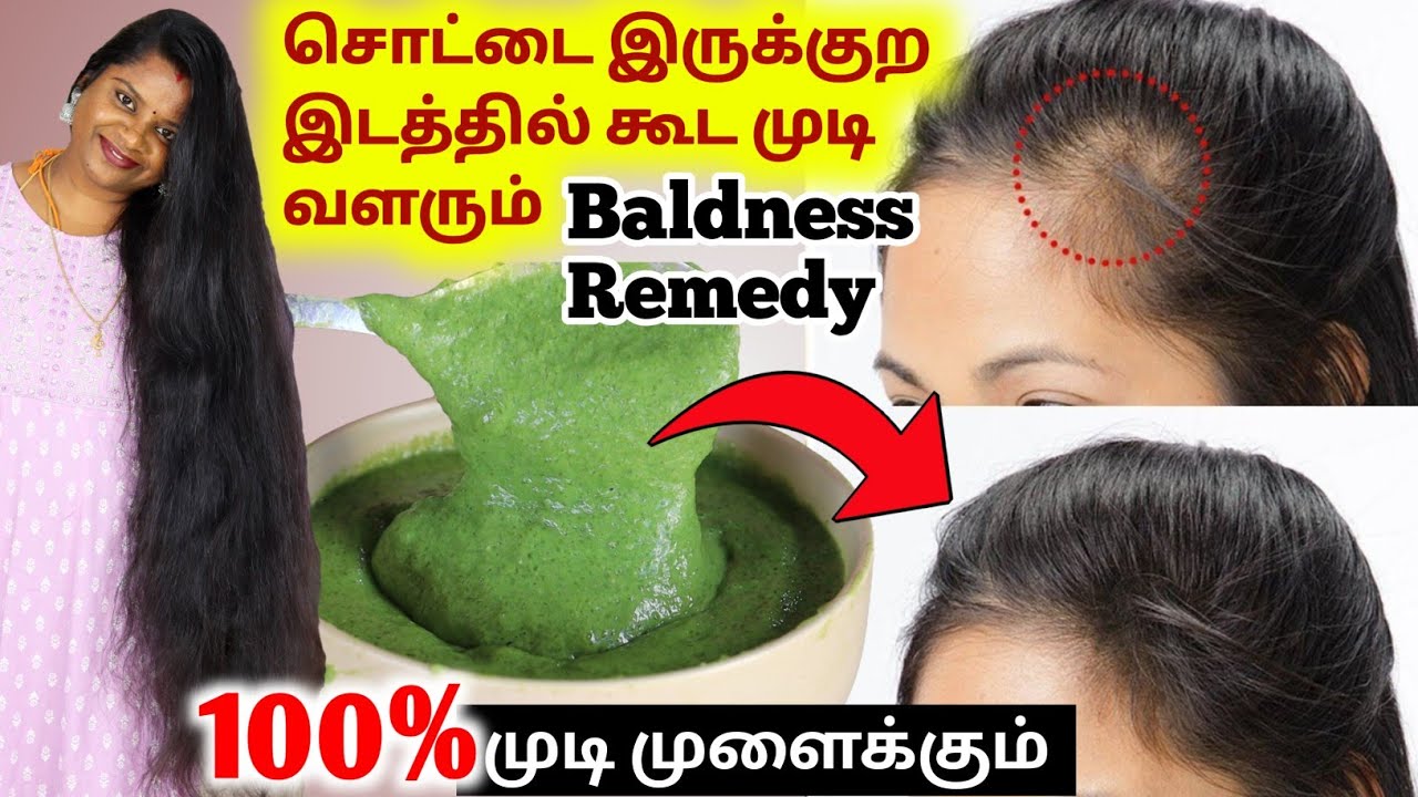 OMG..🔥100% முடி முளைக்கும் / Baldness Hair Growth Remedy / Hair fall solution at home