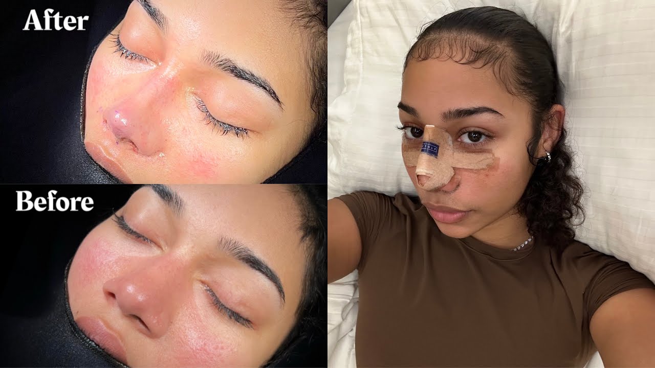 ETHNIC NOSE JOB IN TURKEY WITH THE BEST SURGEON || DO'S & DONT'S