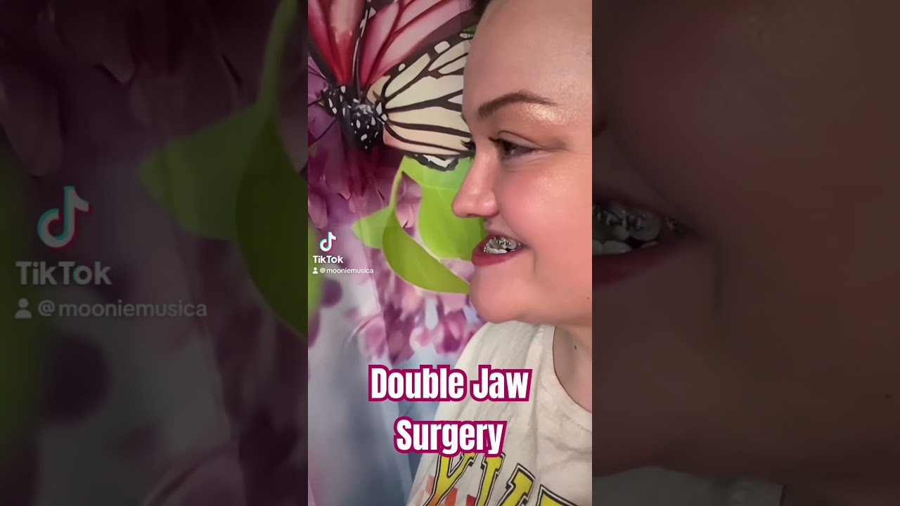 Double jaw surgery and genioplasty! 