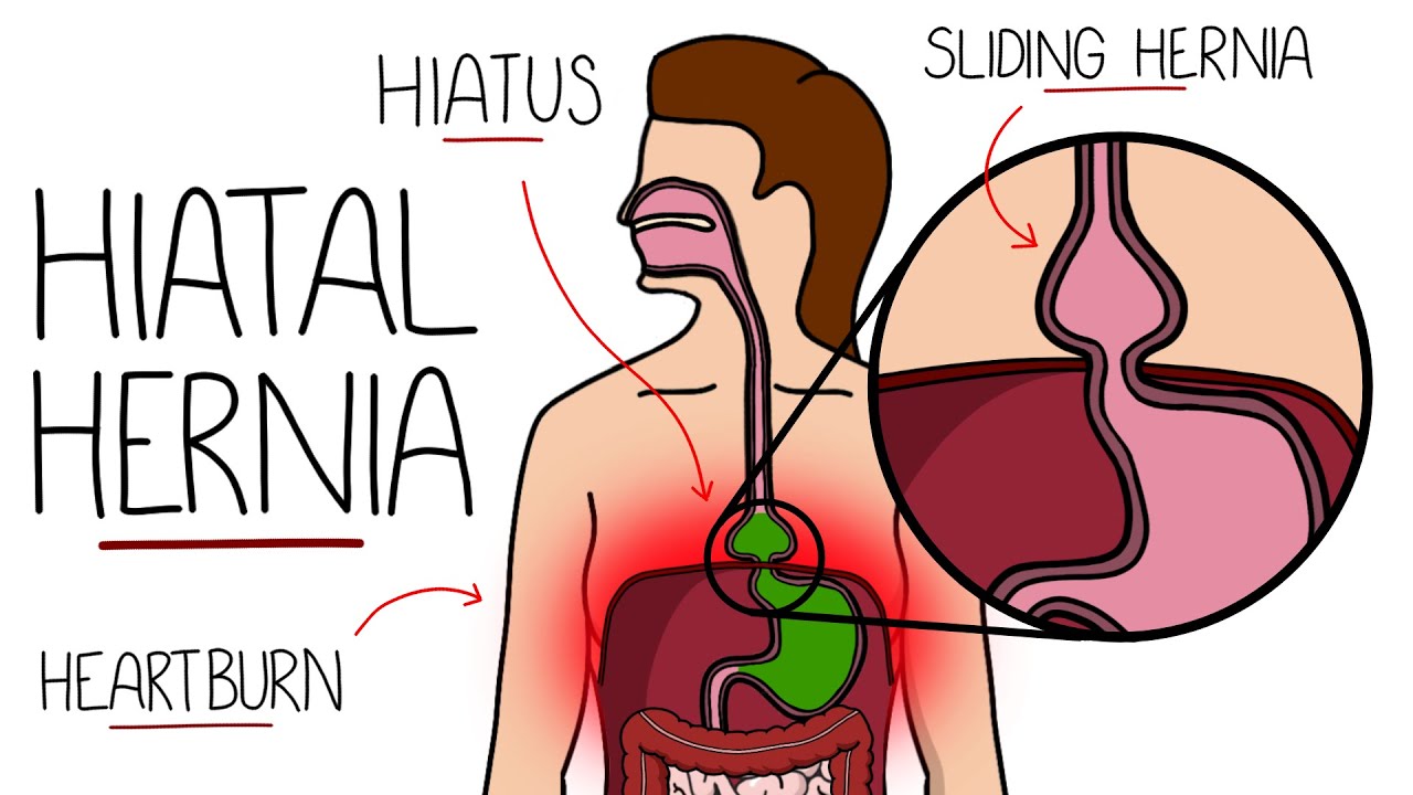 Hiatal Hernia Explained (Hiatus Hernia)