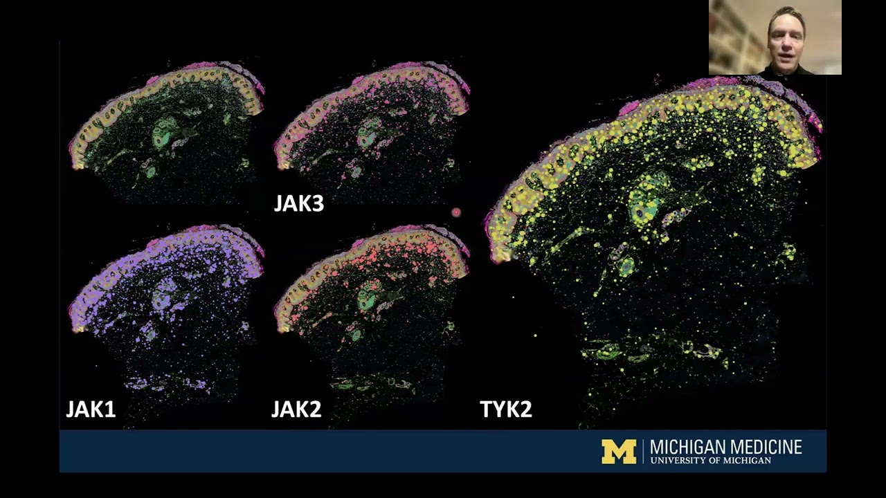 PeDRA Webinar: Exploring the Future of TYK2