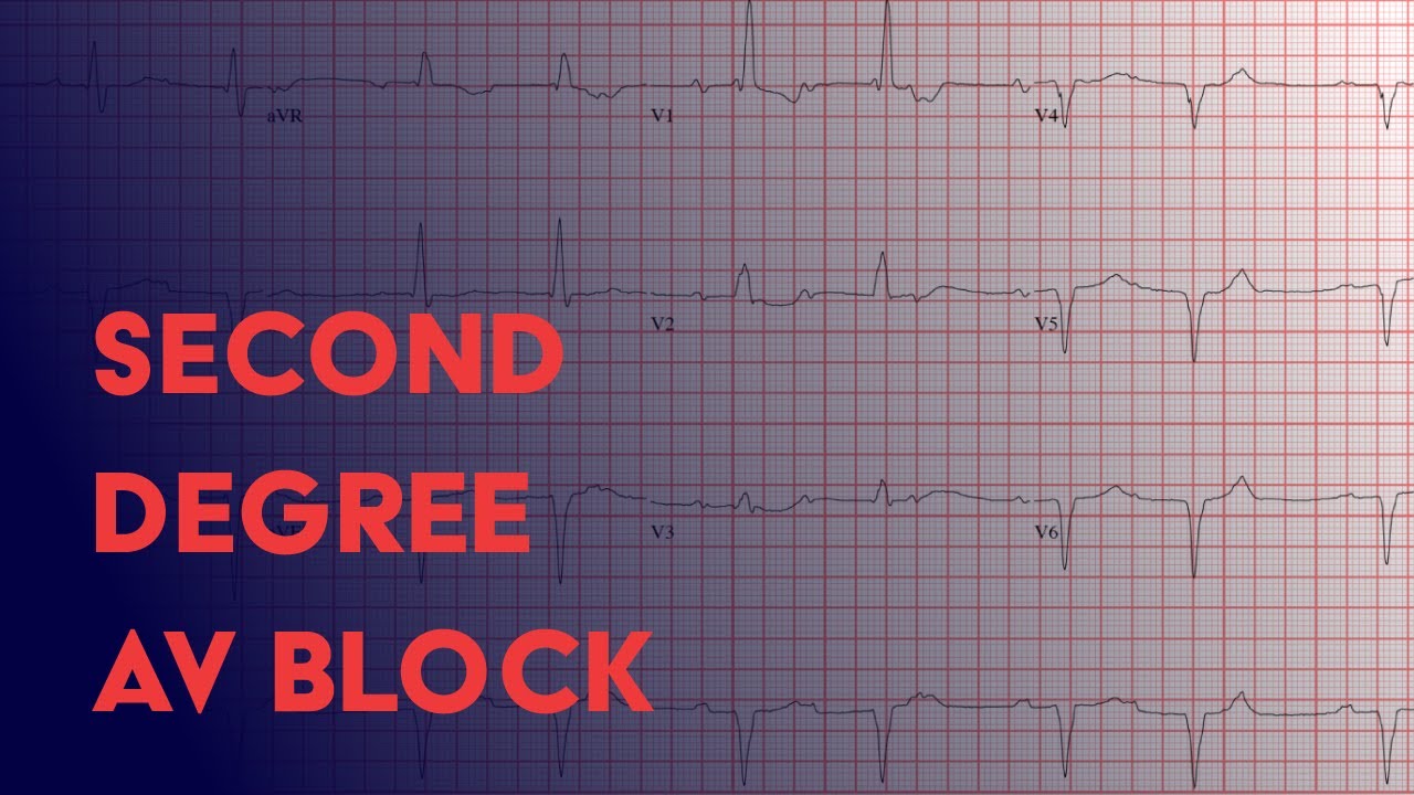 Second Degree Heart Block -  Electrocardiogram (ECG/EKG) Interpretation