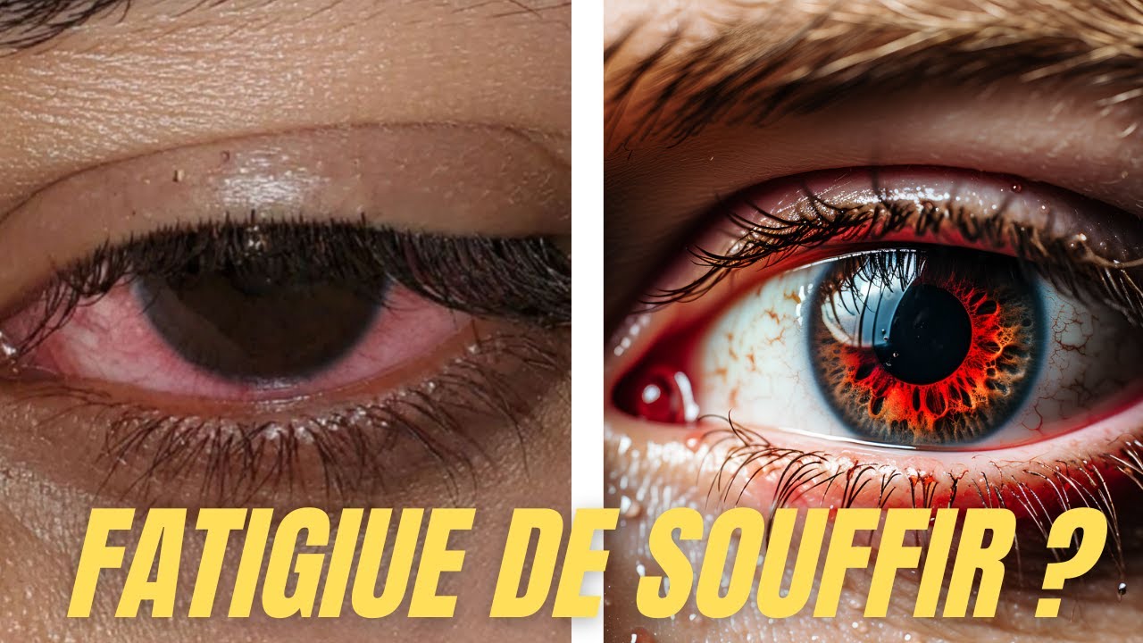Yeux secs chroniques : pourquoi ça ne passe jamais ?