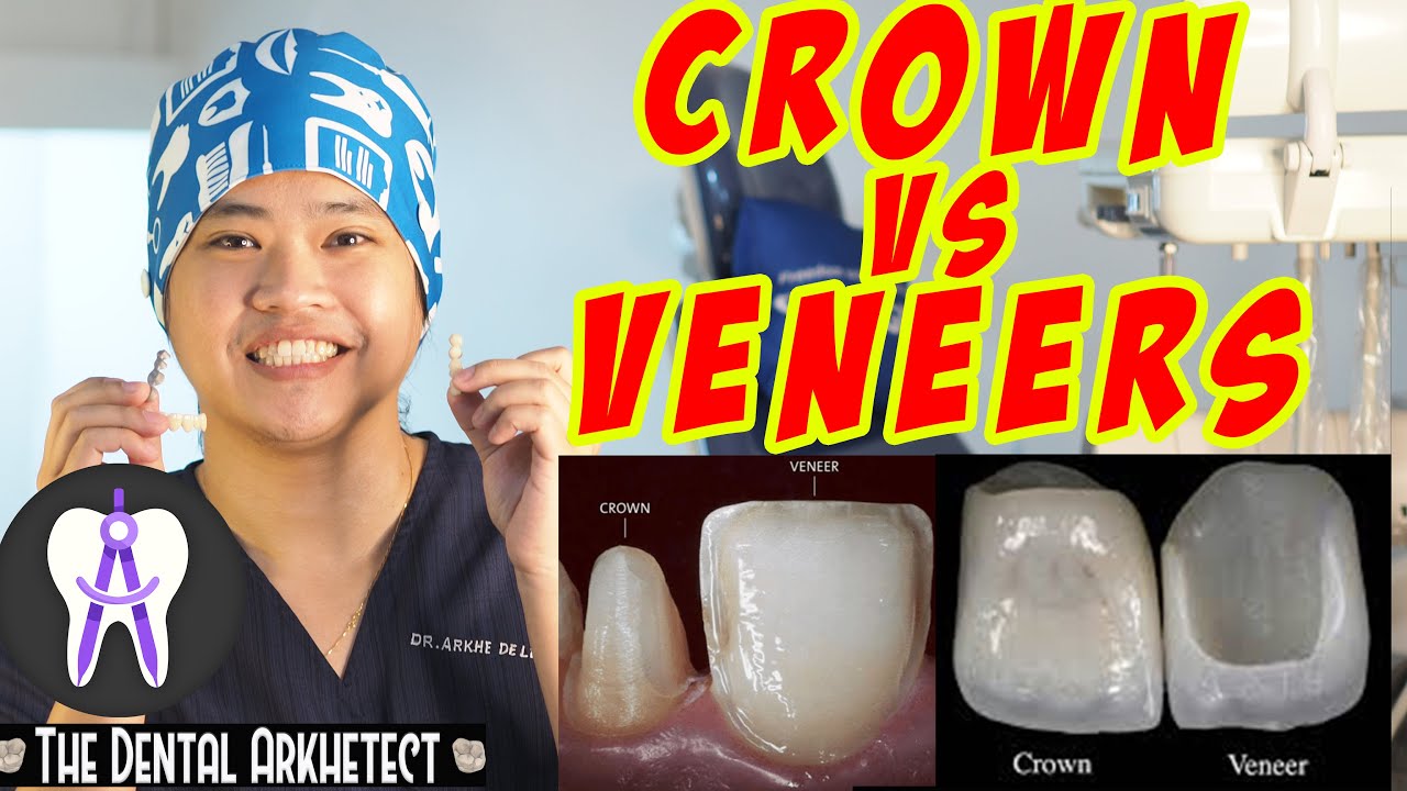Kaibahan ng Dental Veneer at Crown (Jacket) 