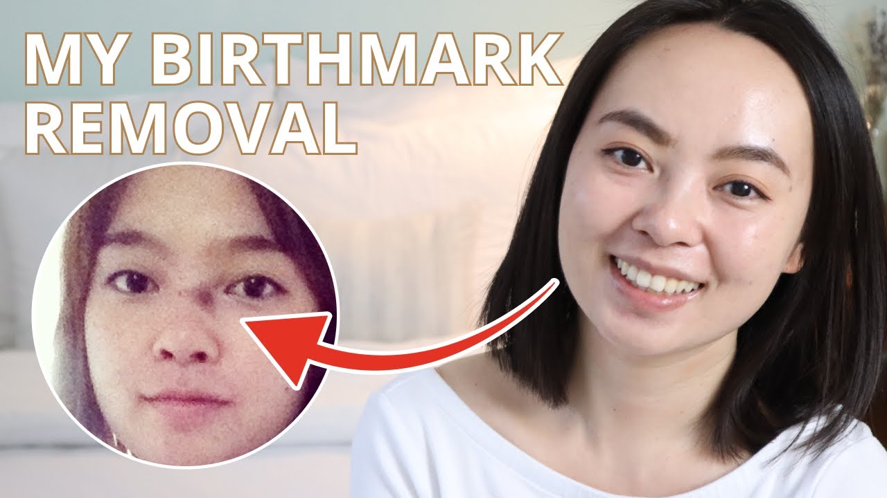 My Birthmark (Nevus of Ota) Removal – 6 Years Later