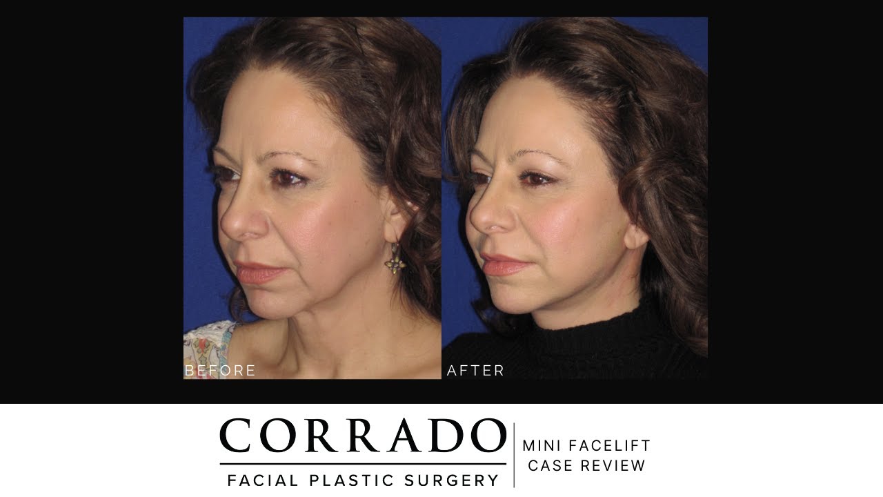 Mini Facelift Before and After Pictures | Dr. Anthony Corrado