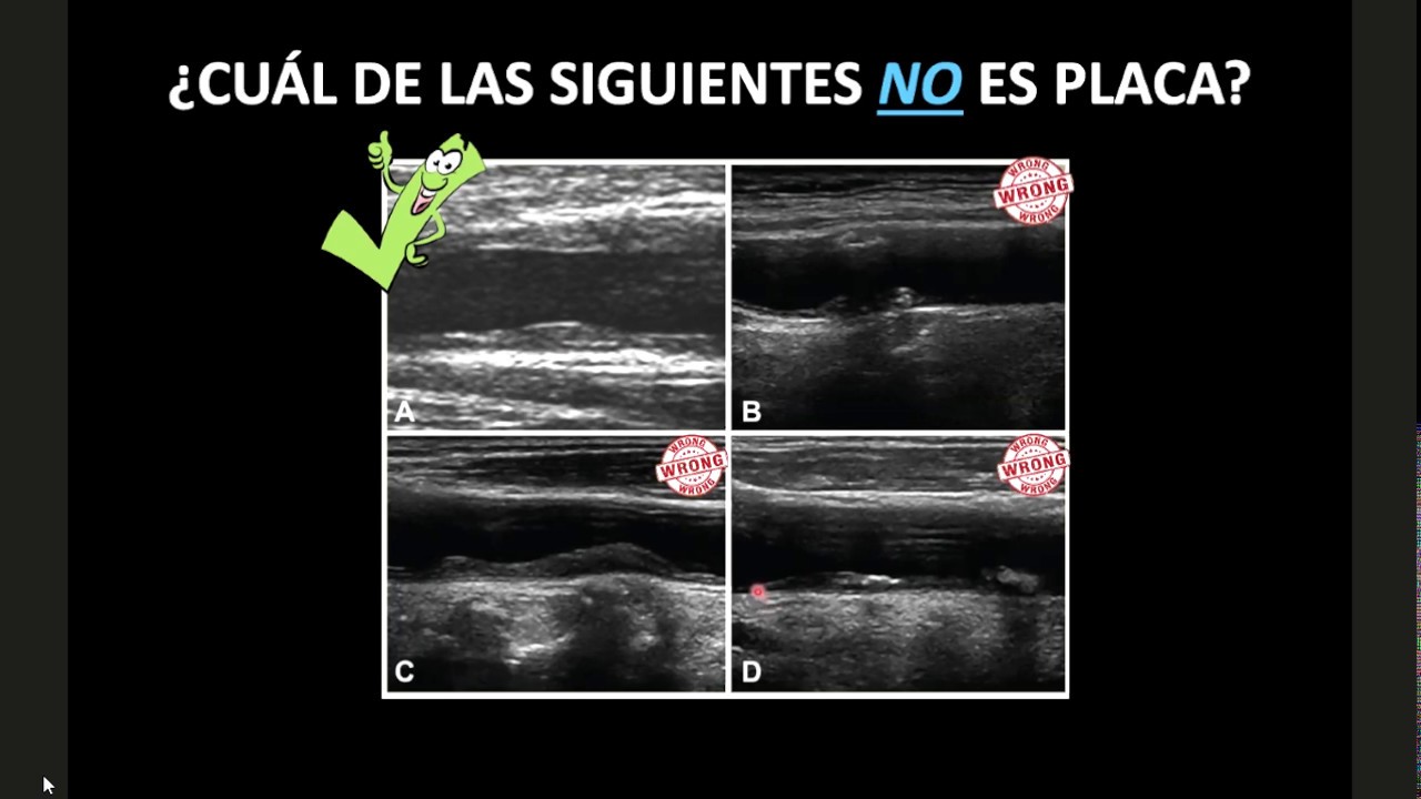DOPPLER CAROTIDEO - PARTE II