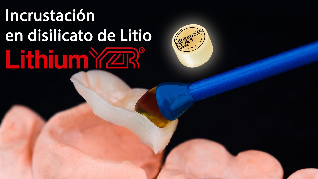 Incrustación en disilicato de litio Lithium YZR