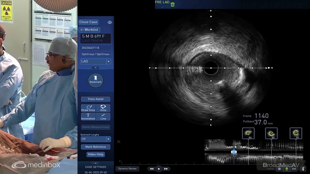 PCI Of LAD Under IVUS Guidance