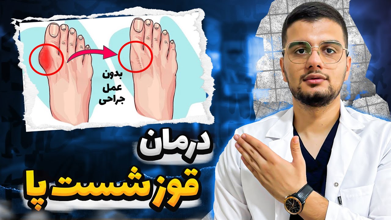 درمان قوز شست پا و هالوکس والگوس با 5 حرکت موثر خانگی