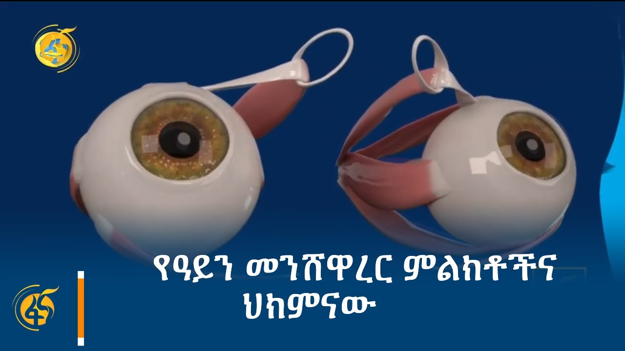 የዓይን መንሸዋረር ምልክቶችና ህክምናው