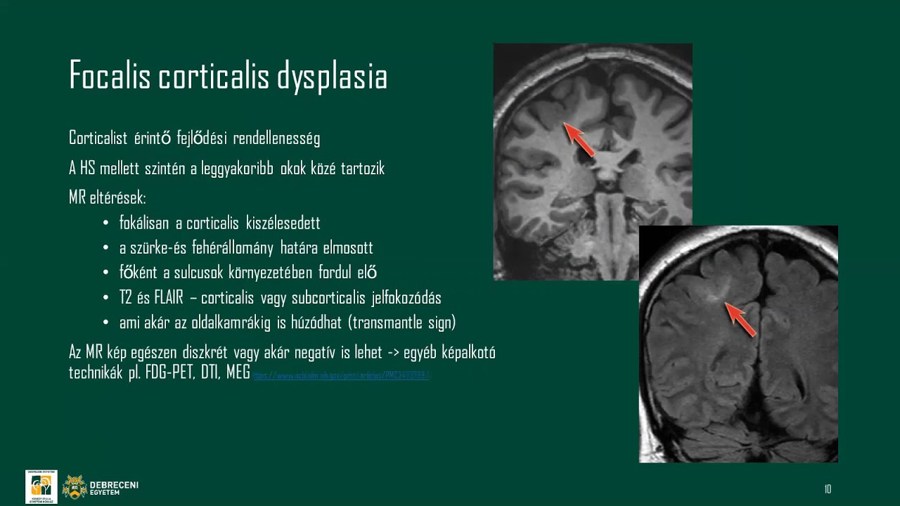 Az epilepsziák képalkotása