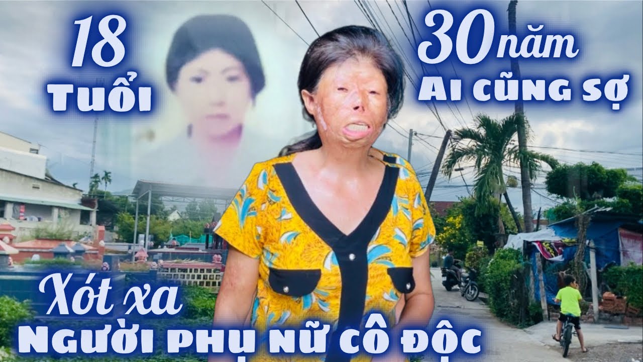 Xót Xa Người Phụ Nữ Cô Độc Gần 30 Năm Sống Trong Dung Mạo Mà Ai Nhìn Cũng Sợ. Cảm Ơn Quý NHT Giúp Đỡ