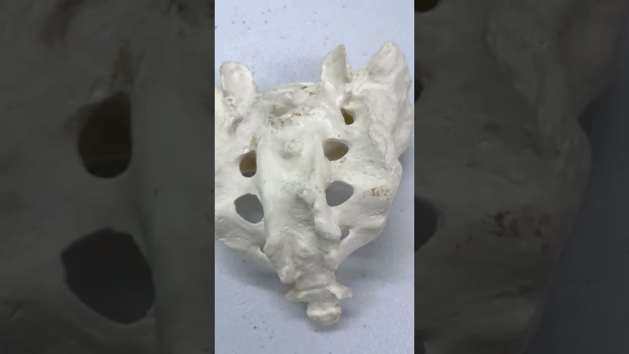 SACRUM - Clinical Functional and Developmental Aspects - Sanjoy Sanyal