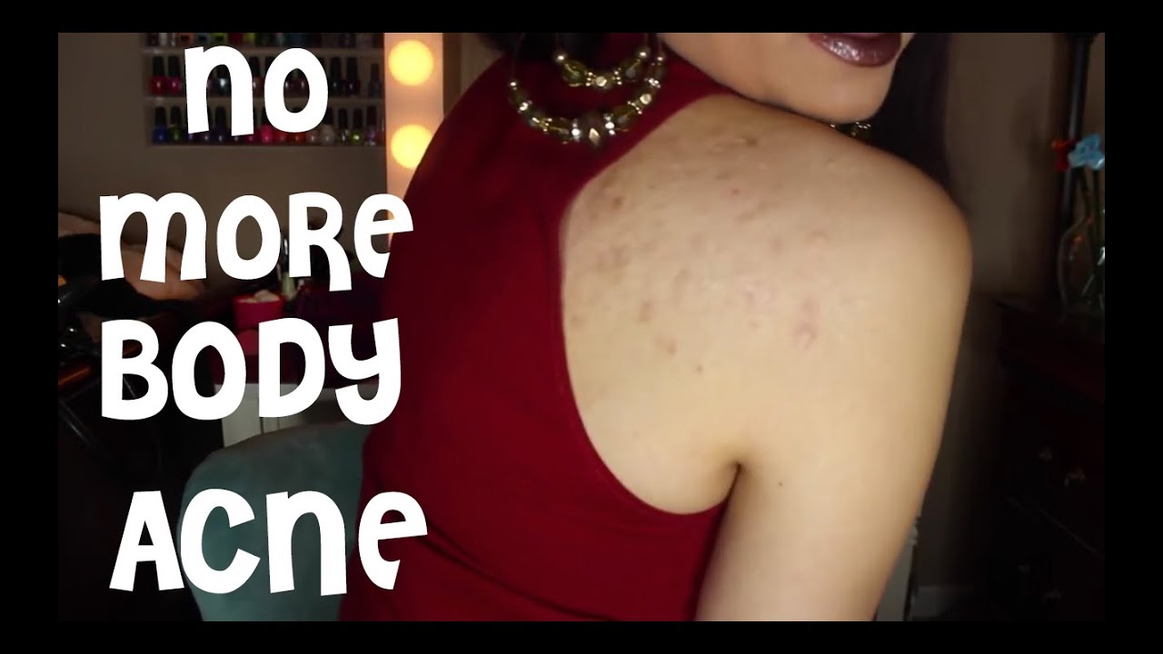 How to Get Rid of Body Acne