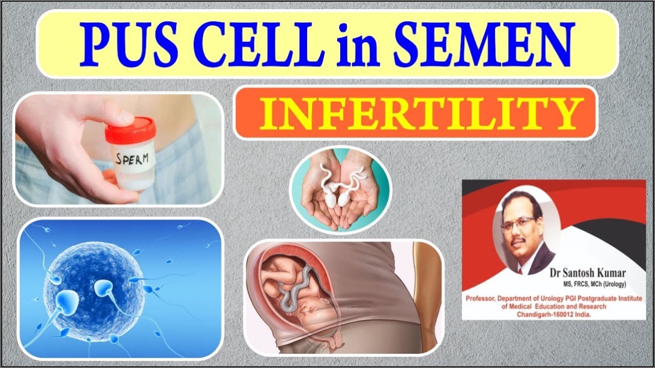 Why do Pus Cells appear in Semen? Pus Cells in Semen - Treatment by Dr. (Prof) Santosh Kumar PGI.
