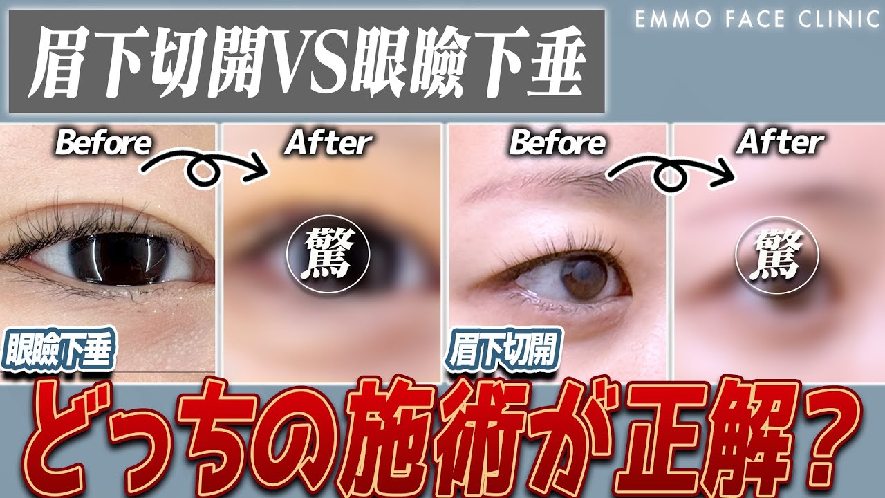 【目の開きで判断】眉下切開？眼瞼下垂？偽性眼瞼下垂、受けるべき手術はどれ？見分け方を図で一発理解！