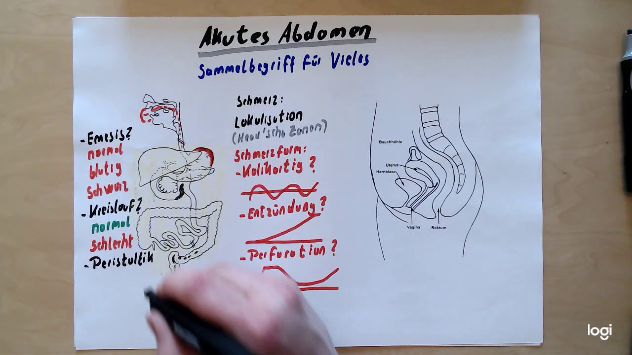 Akutes Abdomen