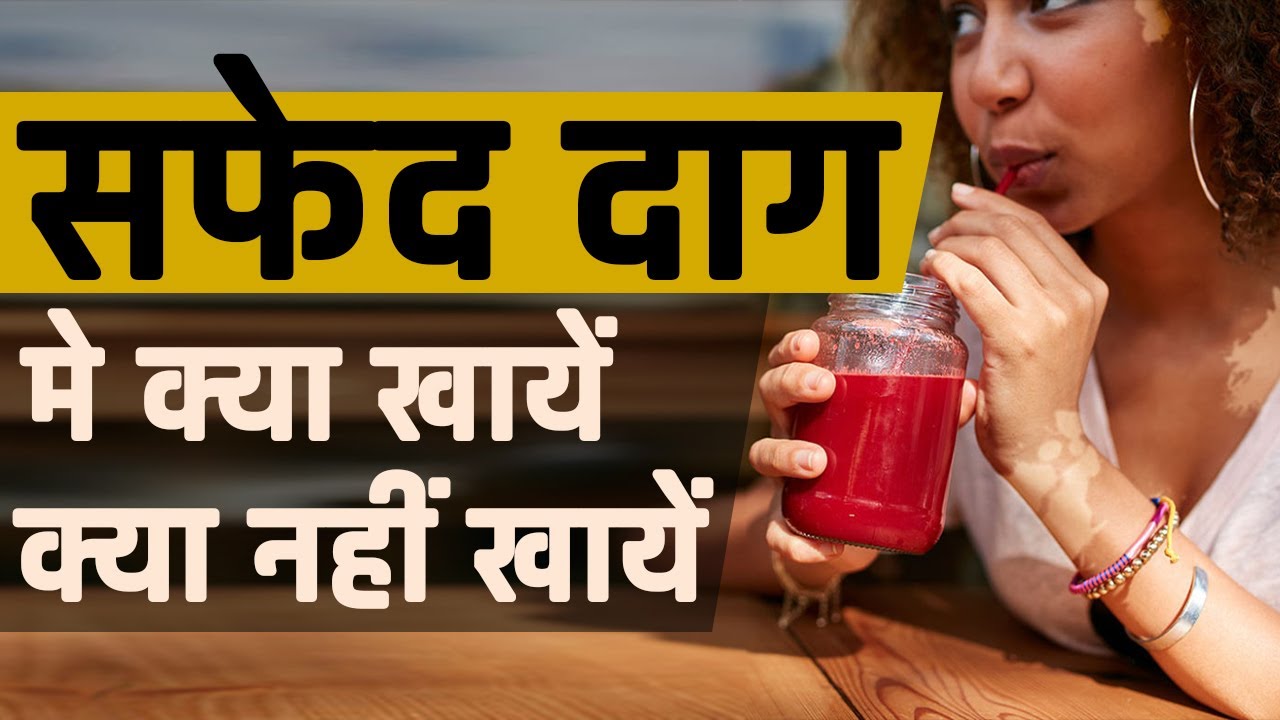 सफेद दाग मे क्या खायें क्या नहीं खायें | Foods and Habits to Avoid in Leucoderma