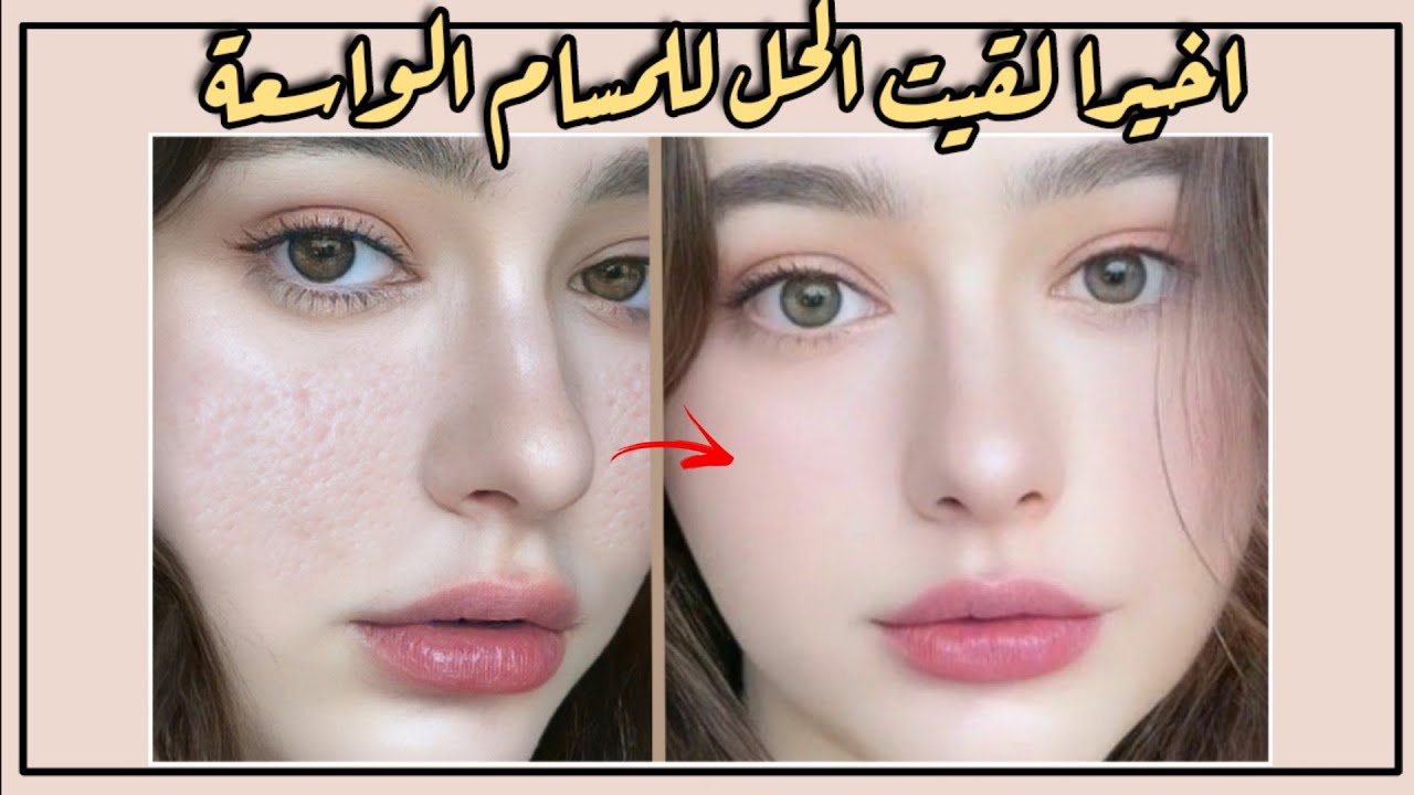 اسرع علاج للمسام الواسعة | افضل علاج للمسامات الواسعه في الوجه في ٣ ايام فقط