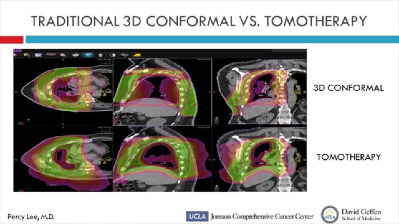 Percy Lee, MD - Postoperative Tomotherapy following Lung-Sparing Surgery for Mesothelioma