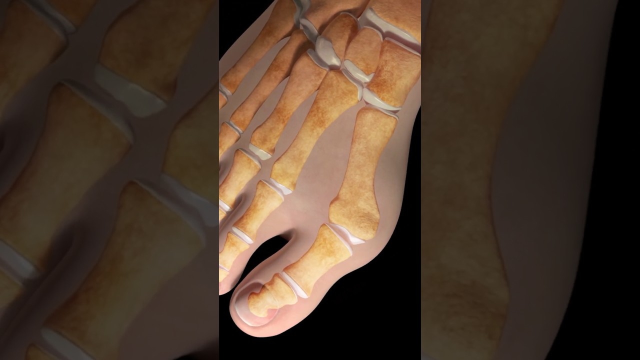 The Truth About Bunions (and Why They Hurt