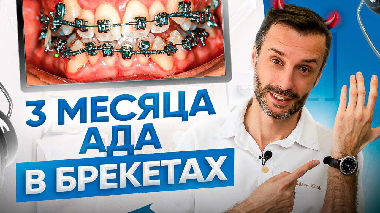 Первые 3 месяца лечения на брекетах — самый сложный период