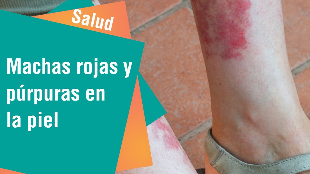 ¿Qué indican las manchas rojas y púrpuras en la piel? | Salud