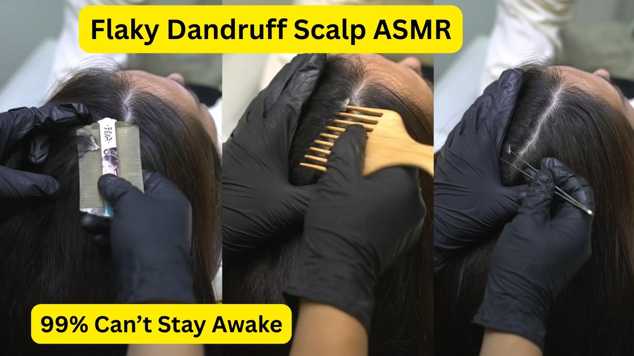 Flaky DANDRUFF Scalp ASMR #asmr #triggersforsleep #asmrscalpscratching #asmr #25 @ASMRAnnieYT ​