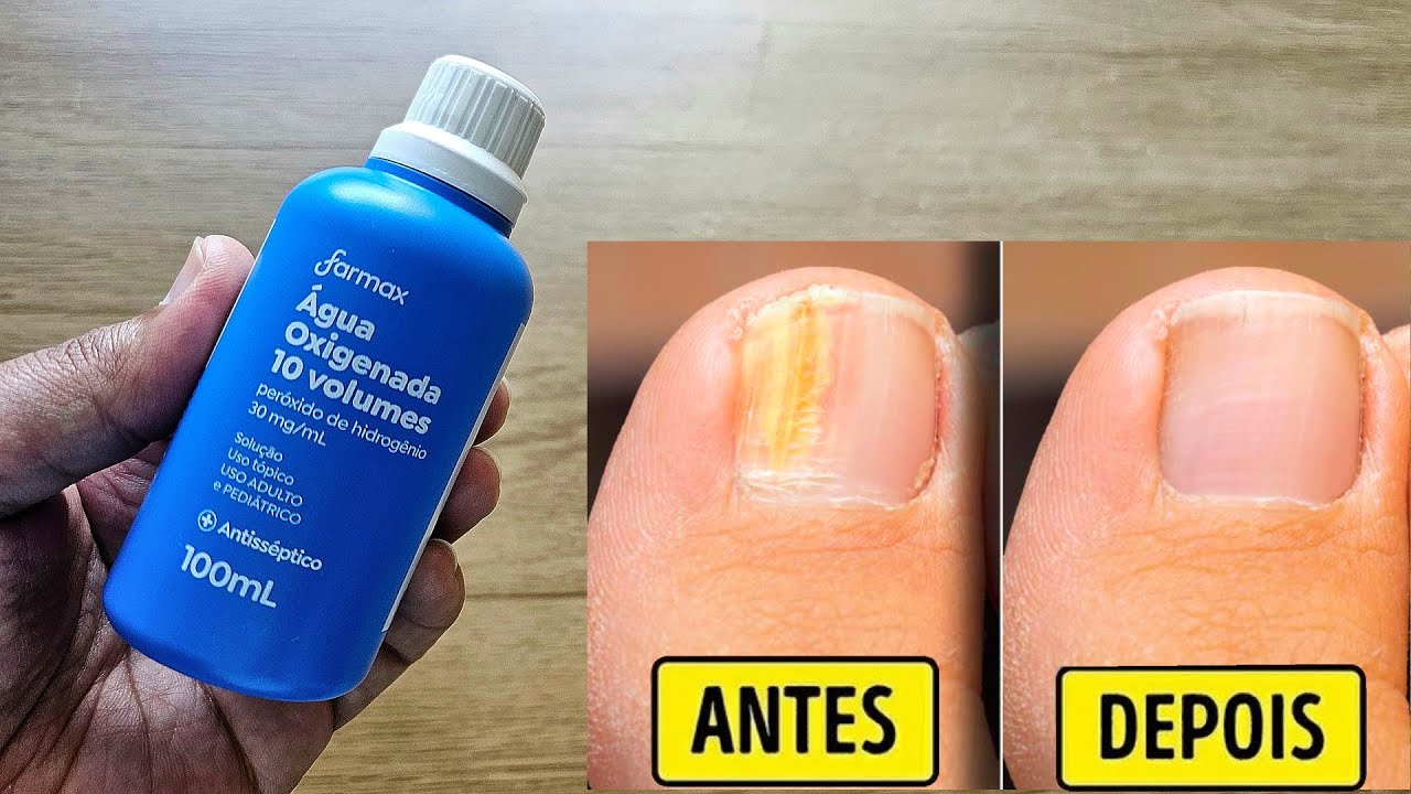 Melhor receita para eliminar MICOSE DE UNHA e Acabar com os Fungos!