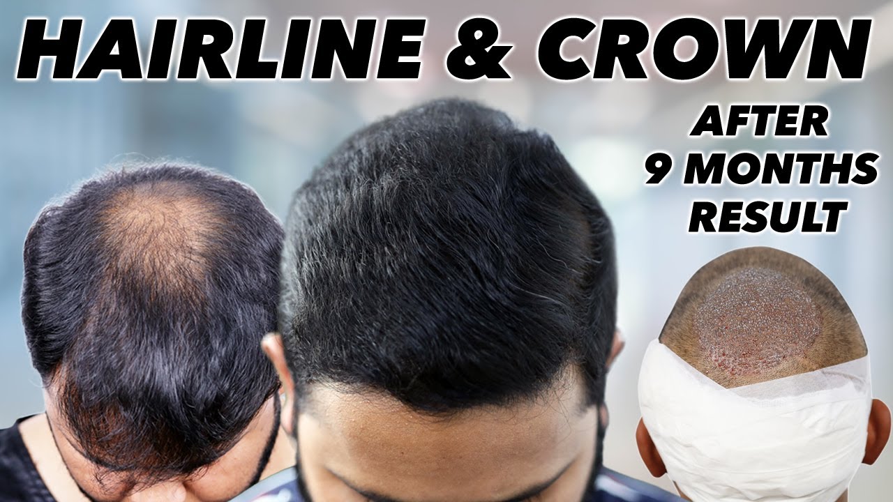 Hair Transplant Results After 9 Months | Hairline & Crown |